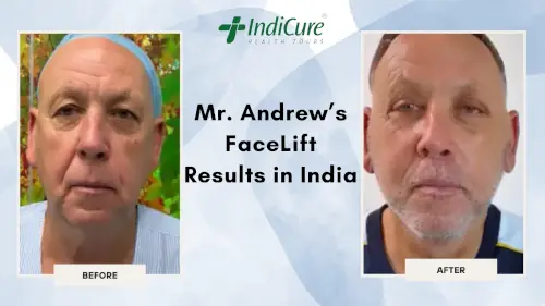 Mr. Andrew's Facelift Results in India